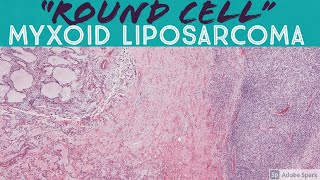 quotRound cellquot High Grade Myxoid Liposarcoma [upl. by Litnahs]