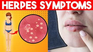 Herpes Simplex  Genital Herpes Oral Herpes Signs amp Symptoms  Herpes Treatment and Home remedies [upl. by Semreh]