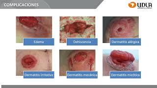 Clase 11 Ostomias y CVC [upl. by Amory]