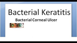 Ophthalmology 111 a Bacterial Keratitis Corneal Ulcer Cornea Bacteria Infective Hypopyon infection [upl. by Sivel839]