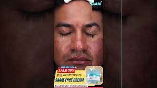 Do you know this melasma solution Remove melasma from 2 weeks melasmacream melasmatreatment [upl. by Iorgos]