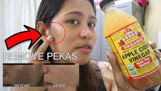 PAANO MATANGAL ANG PEKAS O MELASMA GAMIT ANG APPLE CIDER VINEGAR TIPID AT NATURAL NANPARAAN [upl. by Lleoj]