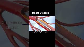 Heart coronary artery disease [upl. by Coralie]