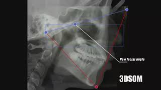 3DSOM ORTHODONTIC Non extraction case of Bimaxillary protrusion [upl. by Teodoor304]