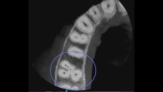 CS 81003D Endodontic 5 Canal Case [upl. by Noland]