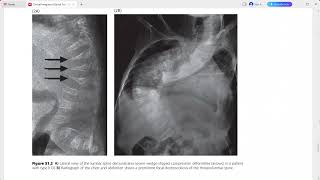 CLINICAL IMAGING OF SPINAL TRAUMA [upl. by Loats353]