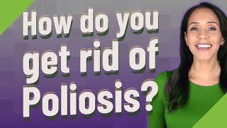 How do you get rid of Poliosis [upl. by Ruthven]