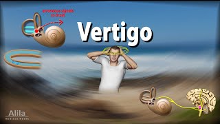 Vertigo Causes Pathophysiology and Treatments Animation [upl. by Shriver218]