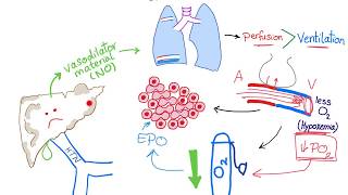 Hepatopulmonary syndrome [upl. by Fernandez288]