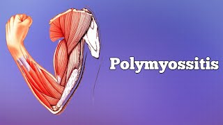 Polymyositis amp Dermatomyositis [upl. by Shoshanna]