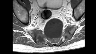 Sacral Chordoma [upl. by Autumn]