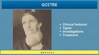 Goitre  Clinical features  EthologyCauses  Types  Investigations  Treatment [upl. by Aettam962]