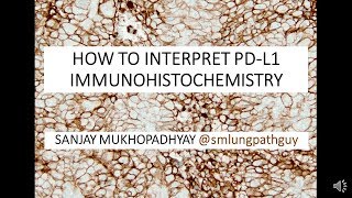 How to interpret a PDL1 immunostain [upl. by Cohbath]