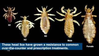 Household product safely cures drug resistant head lice [upl. by Llednav]