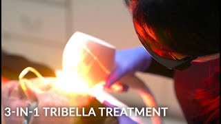 Tribella Treatment with Venus Versa  IPL AntiAging and Skin Resurfacing [upl. by Ecinuahs]