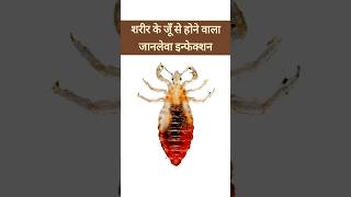 शरीर का जूँ  Body Lice  जानलेवा साबित हो सकता है इससे होने वाला इन्फेक्शन  Pediculosis Corporis [upl. by Vokay]