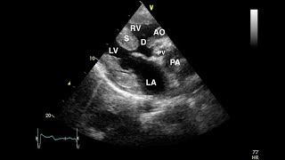 Transposition of the Great Arteries Echocardiography [upl. by Ssirk]