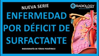 Qué es la enfermedad por DEFICIT DE SURFACTANTE  ¿Enfermedad de MEMBRANA HIALINA 🫁 [upl. by Knapp]