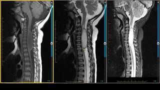 Cervical Spinal Cord Astrocytoma on MRI [upl. by Gudrin]