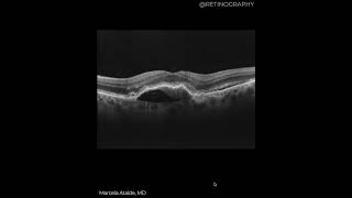 MACULAR NEOVASCULARIZATION TYPE 1 MULTIMODAL AND OCT BIOMARKERS ANALYSIS retina oftalmo ophthalm [upl. by Garald23]