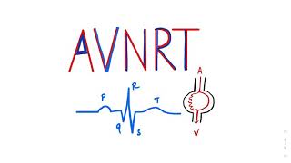 Atrioventricular Nodal Reentrant Tachycardia AVNRT SVT ecgtutorial cardiology AVRT Arrhythmia [upl. by Elagiba]