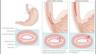 USMLE S2CK Uworld case no 33Boerhaave syndrome [upl. by Auston214]