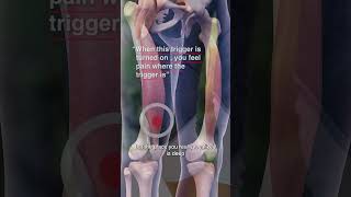 Are Vastus Medialis Trigger Points Causing Your Knee Pain [upl. by Eeslek]