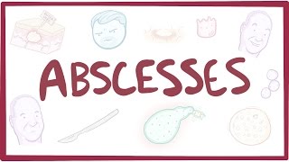 Abscesses  causes symptoms diagnosis treatment pathology [upl. by Stoll]