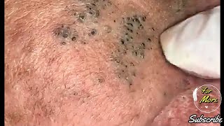 Dr Pop  Deep Blackheads in old Skin removing amp treatment 2020 Part 4 HD [upl. by Anekam]