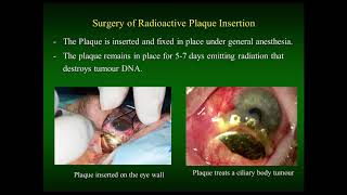 Uveal Melanoma Webinar Treatment Updates and Genetics [upl. by Lauder]