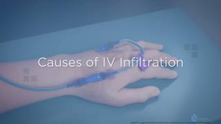 Causes of IV Infiltration  Training Video [upl. by Nnaeitak52]