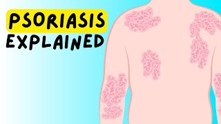 What is Psoriasis Definition Etiology Classification Pathophysiology Diagnosis Treatment [upl. by Polak932]