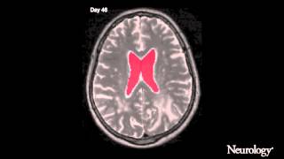 Standard chemoradiation for glioblastoma results in progressive brain volume loss [upl. by Ahsikin]