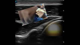 Scanning and Needling Nuances in Ultrasound guided glenohumeral joint injection [upl. by Jada]