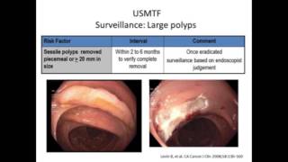 Individualized Approach to Colon Polyps and Colon Cancer [upl. by Aisenet]