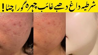 Acne pimples treatment  acne scar treatment  pimple treatment  back acne treatment [upl. by Ardnic]