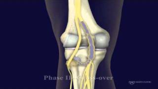 Peroneal and Tibial Intraneural Ganglion Cysts in the Knee Region Video 2 [upl. by Inafetse]