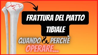 Frattura del Piatto Tibiale  Perchè è necessario lintervento chirurgico [upl. by Nitsirt]