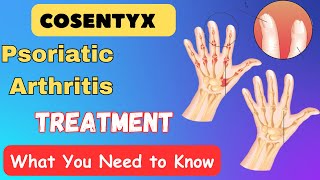 Cosentyx Psoriatic Arthritis Treatment  What You Need to Know [upl. by Loats]