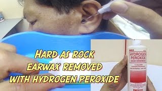 Hard as Rock Earwax Removal using Hydrogen Peroxide [upl. by Janie]