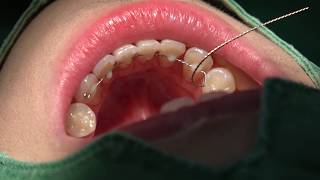 Bonded lingual fixed retainer in 10 min [upl. by Immaj]