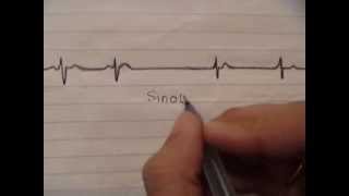 ECG simplified  Sinoatrial block [upl. by Llimaj]