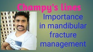 Champys lines of osteosynthesis [upl. by Trauner]