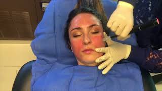 Microneedling with PRP Platelet Rich Plasma quotVampire Facialquot [upl. by Maia215]