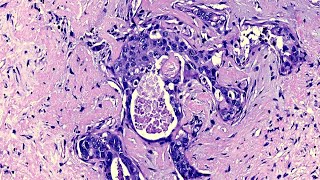 Invasive Ductal Adenocarcinoma ExPleomorphic Adenoma Lacrimal Gland [upl. by Elleirua]