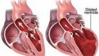 Cardiomyopathy Symptoms │ Symptoms of Cardiomyopathy [upl. by Rawlinson]