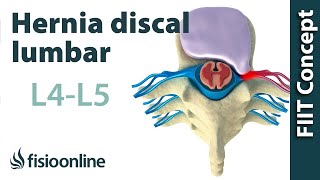 Hernia discal lumbar entre la L4 y L5 o cuarta y quinta vértebras lumbares [upl. by Latonia839]