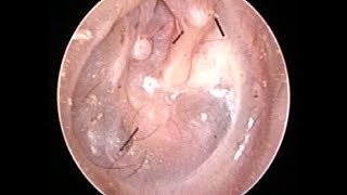 Otoendoscopy  Retracted Ear Drum [upl. by Yaresed897]