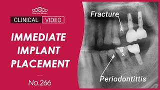 25 35 36 Immediate implant placement after extraction  DrCho Yongseok [upl. by Edan]