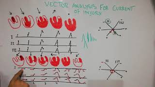 CVS physiology 39 Vectorial analysis for current of injury [upl. by Otrebmuh]